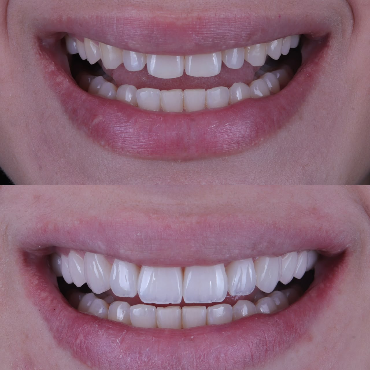 Antes e depois lentes de porcelana