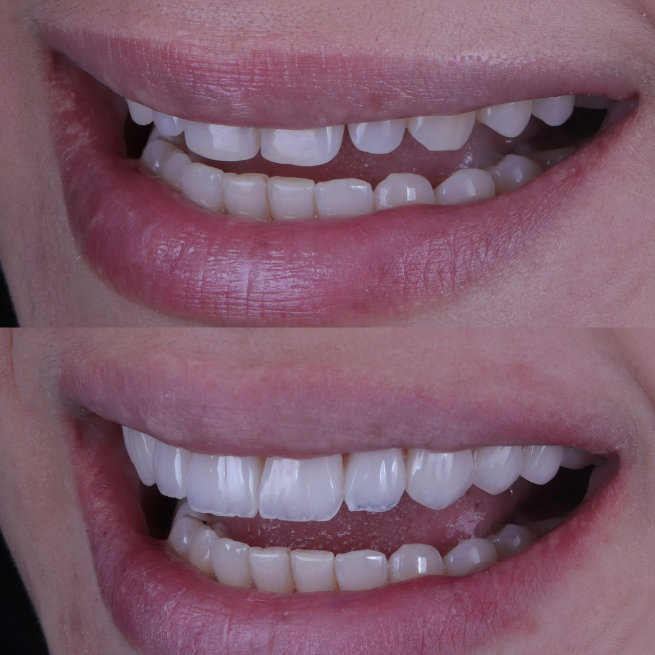Antes e depois reabilitação estética