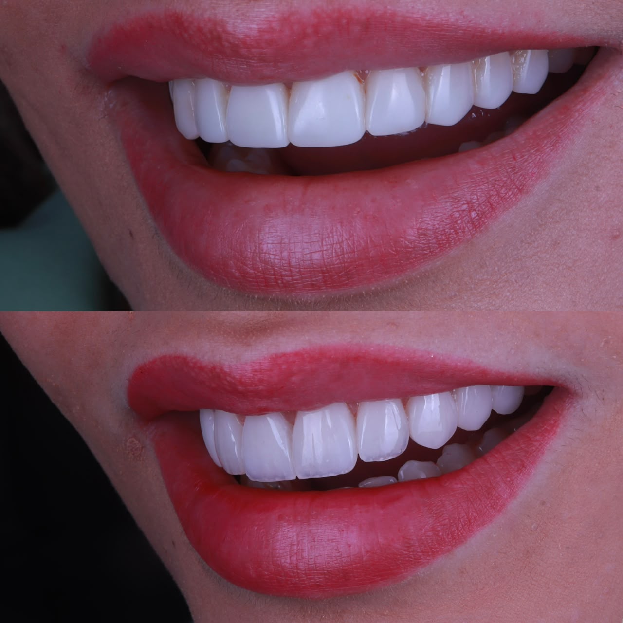 Antes e depois sorriso